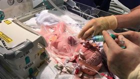 小女嬰威金絲心臟長在體外，媽媽堅持不墮胎活下來。翻自《Business Insider》