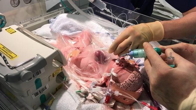 感動！女嬰心臟外露熬過手術奇蹟存活