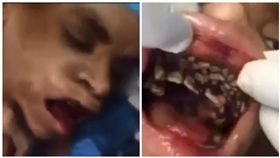 男子,口腔裡爬滿蛆蟲,口腔蠅蛆病（圖／翻攝自YouTube）
