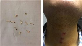 大陸浙江杭州一名31歲陳姓男子，為了保平安，7年前請了一名泰國大師在他體內植入12支金屬「辟邪釘」，其中有3支釘子還深埋在陳男的喉結附近，直到近日陳男因覺得身體不適到醫院檢查，動了2次手術後才成功將金屬釘狀物全數取出。（圖／翻攝自環球網）