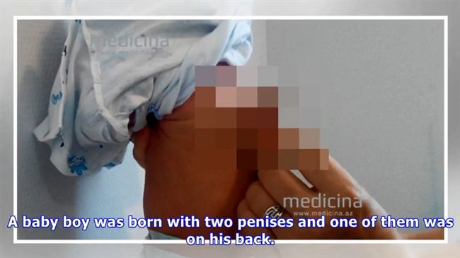 男嬰背上多一根！原來是雙胞胎弟送的