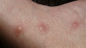 癢,抓癢,蚊子叮,蚊子咬 示意圖／翻攝自Pixabay
