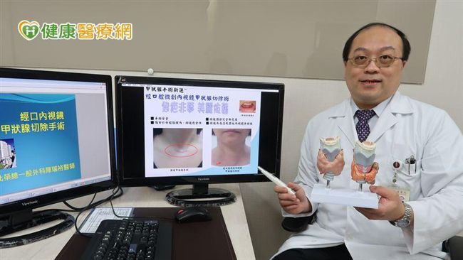 甲狀腺經口切除不留疤　愛美女性新選