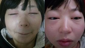 女網友撿菜尾隔天睡醒腫到變豬頭，嚇壞眾人。（圖／翻攝爆怨公社）