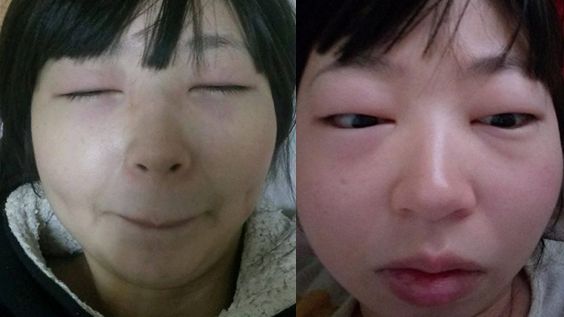 女睡醒腫成豬頭樣　全都因「太貪吃」