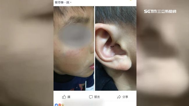怒控老師熱熔膠條打！男童臉腫耳結痂