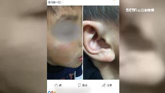 怒控老師熱熔膠條打！男童臉腫耳結痂