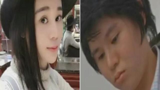 瑜珈正妹微整　竟害自己失智殘疾終身