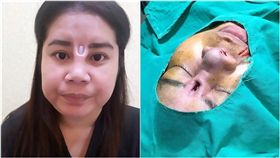 泰國,整容,價格,低廉,廉價,隆鼻,手術,填充物,矽膠棒,整形 圖翻攝自／ห้องสืบสวย-สยอง臉書　https://goo.gl/cWDyck