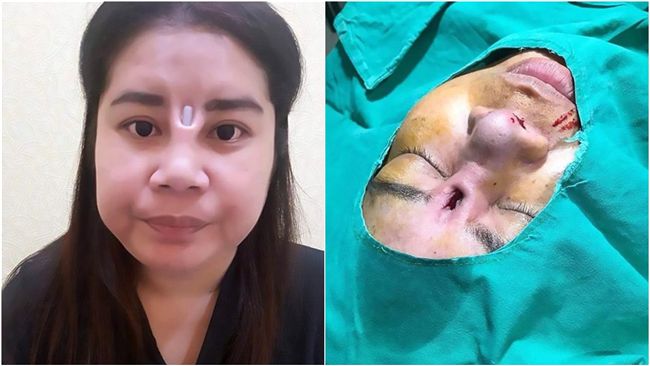 泰女整容失敗！棒狀填充物直穿出眉