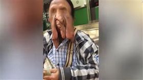 罕見疾病　神經纖維瘤　翻攝影片