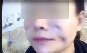 整容整出8個坑！她崩潰求償　美容機構：想要美先變鬼
（圖／翻攝自《湖南都市頻道》）