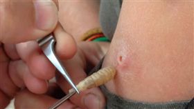 女子傷口夾出白色蛆蟲（圖／翻攝自YouTube）