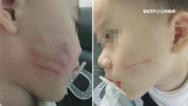 2歲童雙頰瘀青滿是傷　父控保母施虐