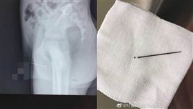 中國大陸,男童,繡花針,下體(微博)