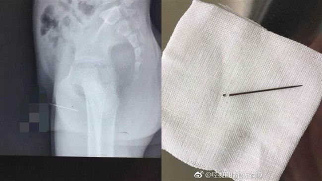 童拿繡花針插下體　取出竟生鏽斷兩半