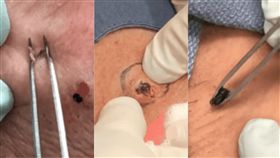 粉刺,痘痘,黑頭,噁心,紓壓,Sandra Lee,YouTube,膿瘡,擠痘痘,2017　圖／翻攝自YouTube https://goo.gl/UUwsrB