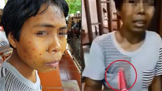 外傭臉畫紅斑裝病　雇主紙巾一擦戳謊