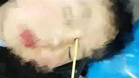 陸男童跌倒　關東煮竹籤插眼睛（圖／翻攝自溫州晚報）