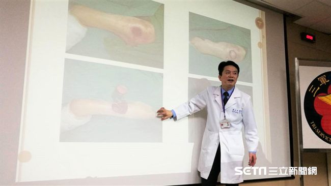 他坐輪椅引褥瘡發燒　「雨傘骨」救命