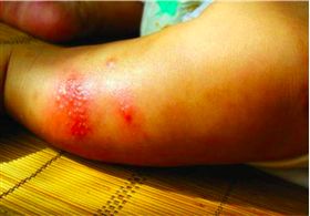 疥瘡,翻攝自微博