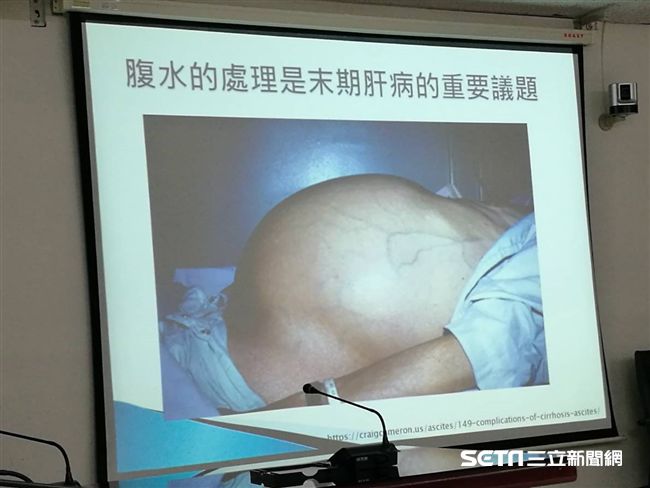 腹水是肝硬化末期常見且重要的併發症,處理得當可以大幅提升病患生活品質。(圖/記者楊晴雯攝)