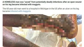 遊民小腿嚴重潰爛,蛆蟲寄生（圖／翻攝自太陽報）
https://www.thesun.co.uk/news/5311378/grim-video-shows-homeless-mans-leg-crawling-with-maggots-but-doctors-say-it-saved-him-from-deadly-infections/