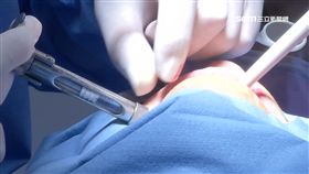 -牙醫-看牙-拔牙-植牙-