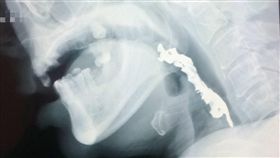 男用餐不慎吞假牙　緊急就醫取出南投縣一名50歲張姓男子用餐時不慎將整排假牙吞入，卡在咽喉，所幸緊急就醫後，順利透過異物鉗夾出。（衛生福利部南投醫院提供）中央社記者蕭博陽南投縣傳真　107年1月16日