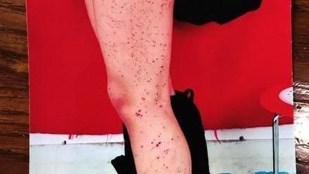 女學生被同學刺滿腿傷　校方：開玩笑