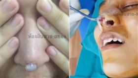 矽膠撐破鼻頭彈出！醫生拔掉…鼻子「開大洞」