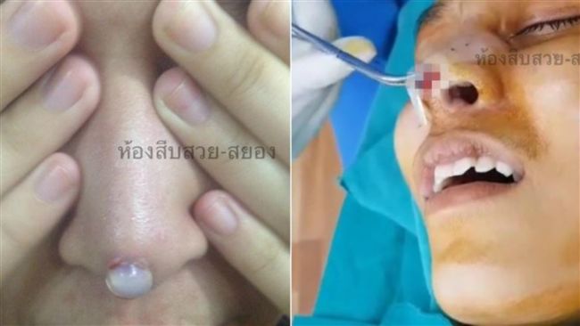 貪便宜找密醫隆鼻　矽膠「穿破鼻頭」