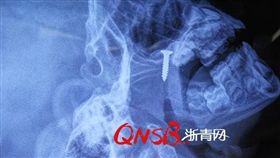 4歲男童睡覺嚴重打呼還會中止呼吸，檢查後發現鼻腔內有個螺絲釘。（圖／翻攝浙青網）