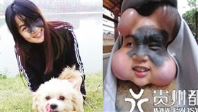 為去除臉上一大片黑痣，肖艷決定動手術，要頂著葫蘆臉長達8個月。（圖／翻攝貴州都市網）