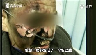 鼻插氧氣管犯菸癮　男一點火臉被燒黑