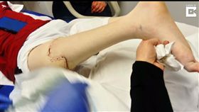 愛爾蘭,特里斯汀,右腳,滑囊肉瘤,惡性滑膜瘤,截肢,義肢(圖/https://www.youtube.com/watch?v=HKctEw22zoI)