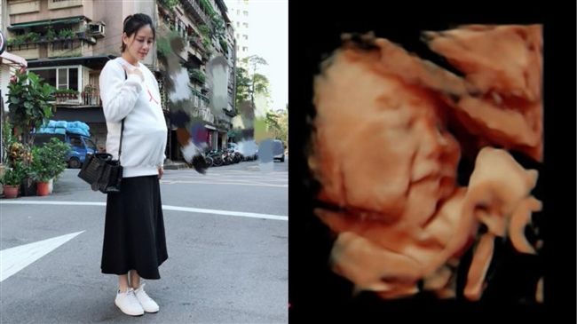 嚴立婷緊急住院！懷孕8個月恐早產