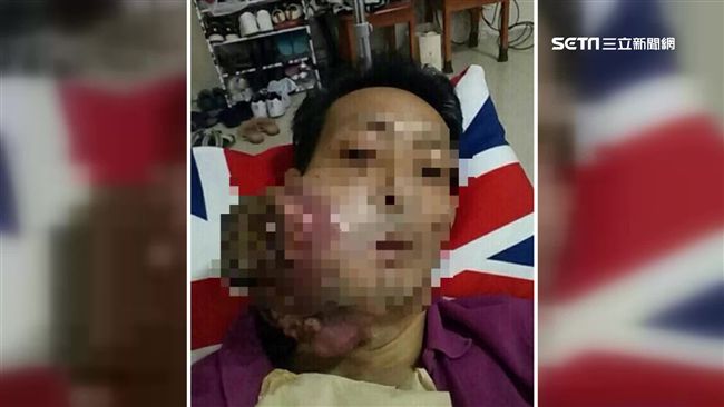 假藥2百賣6千　罹癌台商爆巨瘤亡！