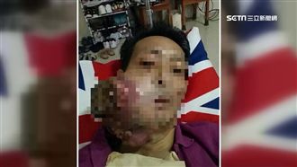 假藥2百賣6千　罹癌台商爆巨瘤亡！