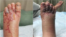 鉤蟲入侵情侶腳掌紅腫化膿。（圖／Katie Stephens、
Eddie Zytner臉書）