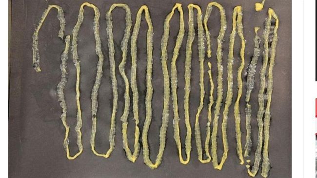 常常吃生魚片！他拉出2.8米寄生蟲