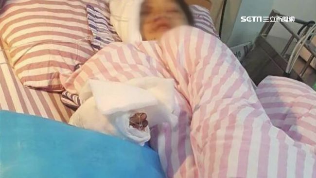 陸手機爆炸　男童渾身血斷指失明