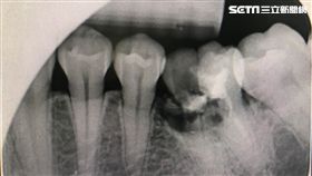 阮綜合醫院,牙科,醫師,陳湘蓁,過年,蛀牙,牙齒,零食