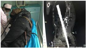 中國大陸一工人肛門遭鋼筋插入貫穿體腔（合成圖／翻攝自太陽報、微博）
