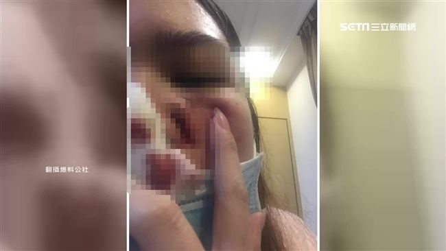 柴犬狠咬害毀容　寵物美容師求償無門