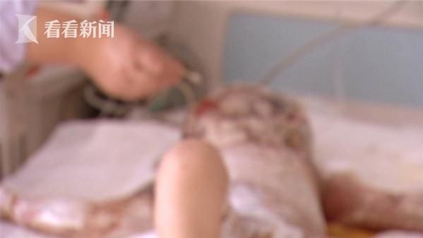 1歲女嬰跌沸水鍋　爺急脫衣撕全身皮