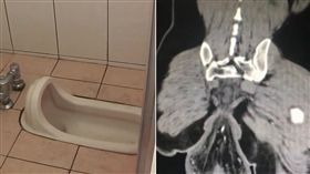 蹲式廁所、直腸壁X光圖（合成圖／資料照；翻攝騰訊影音）