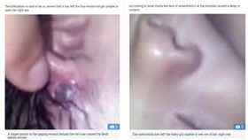 巴西女嬰臉部肌膚遭寄生蟲啃食（圖／翻攝自太陽報）
https://www.thesun.co.uk/news/5533149/worms-eating-holes-baby-face-brazil/