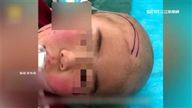  媽媽...好痛啊! 2歲童玩剪刀跌倒插臉6cm