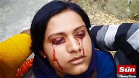 印度21歲人妻吉塔（Geeta）疑似罹患淚血症，雙眼不斷流血淚（圖／翻攝自太陽報）
https://www.thesun.co.uk/news/5559499/wife-21-labelled-a-witch-by-her-husband-due-to-rare-condition-that-sees-her-sweat-blood-from-her-eyes/
